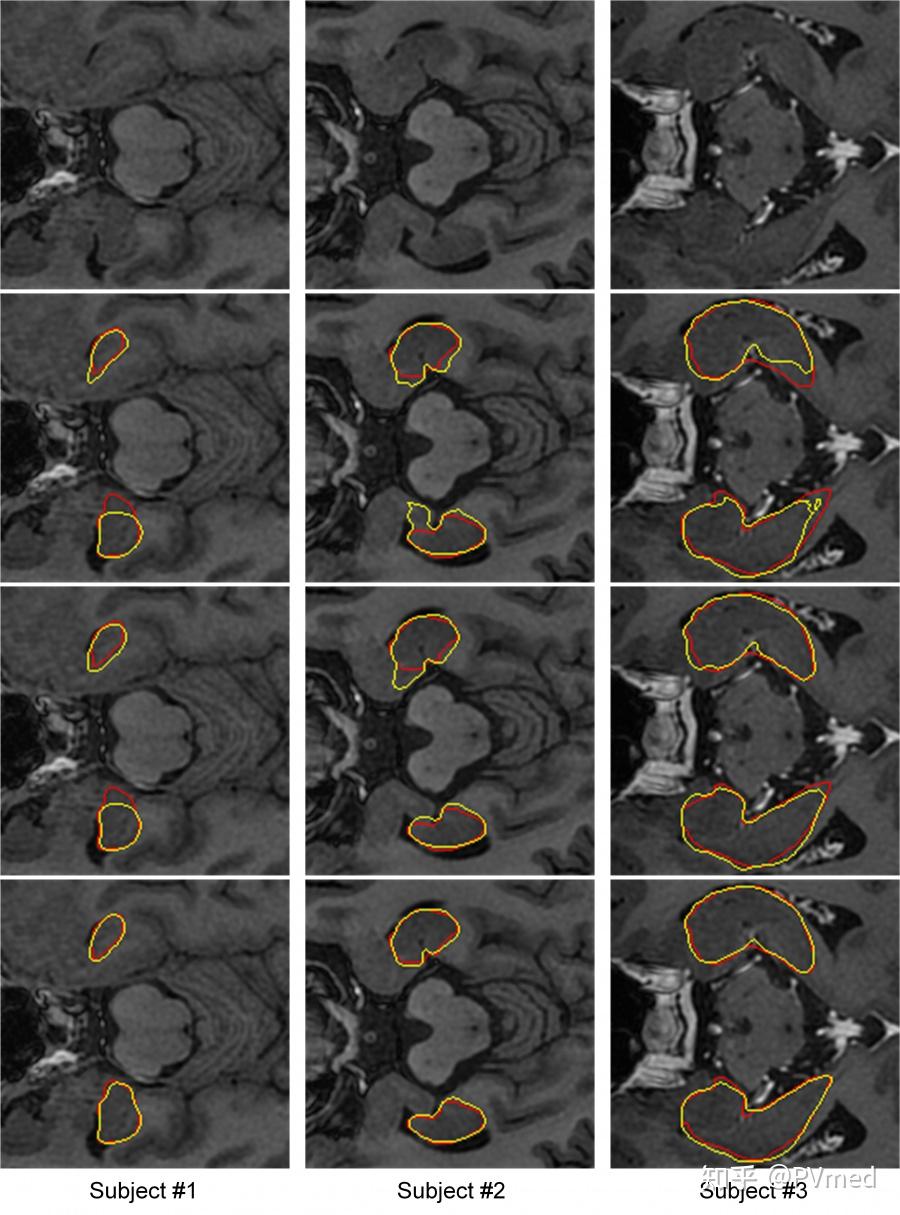 medical physics || 柏视医疗与山东省肿瘤医院海马体自动分割相关