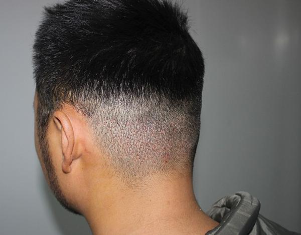 关于植胡须手术?