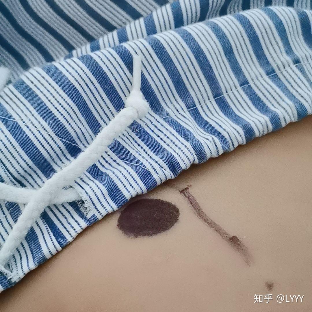 骶尾部畸胎瘤病例少希望能帮到同病的人