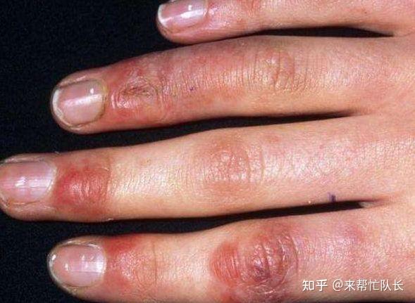 为什么得了冻疮的人每年都容易复发?这些妙招可以帮你缓解 - 知乎