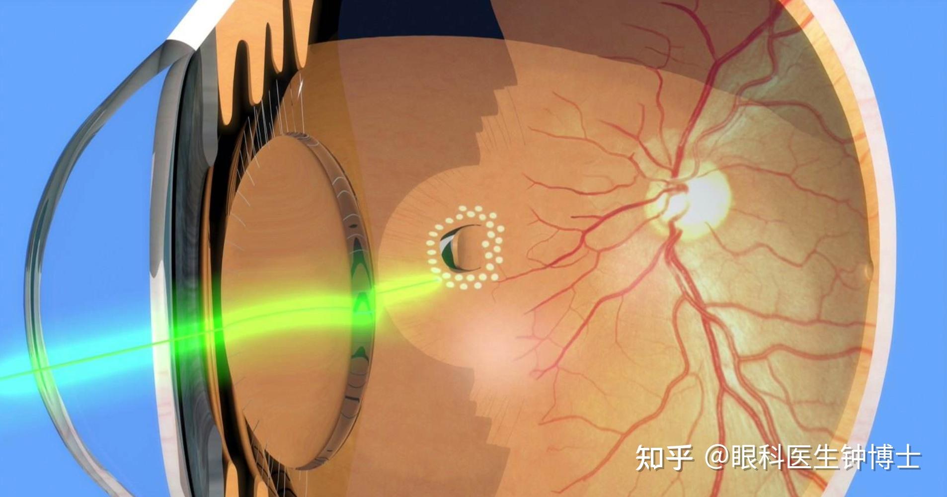 视网膜血管性疾病——4、家族性渗出性玻璃体视网膜病变 - 知乎