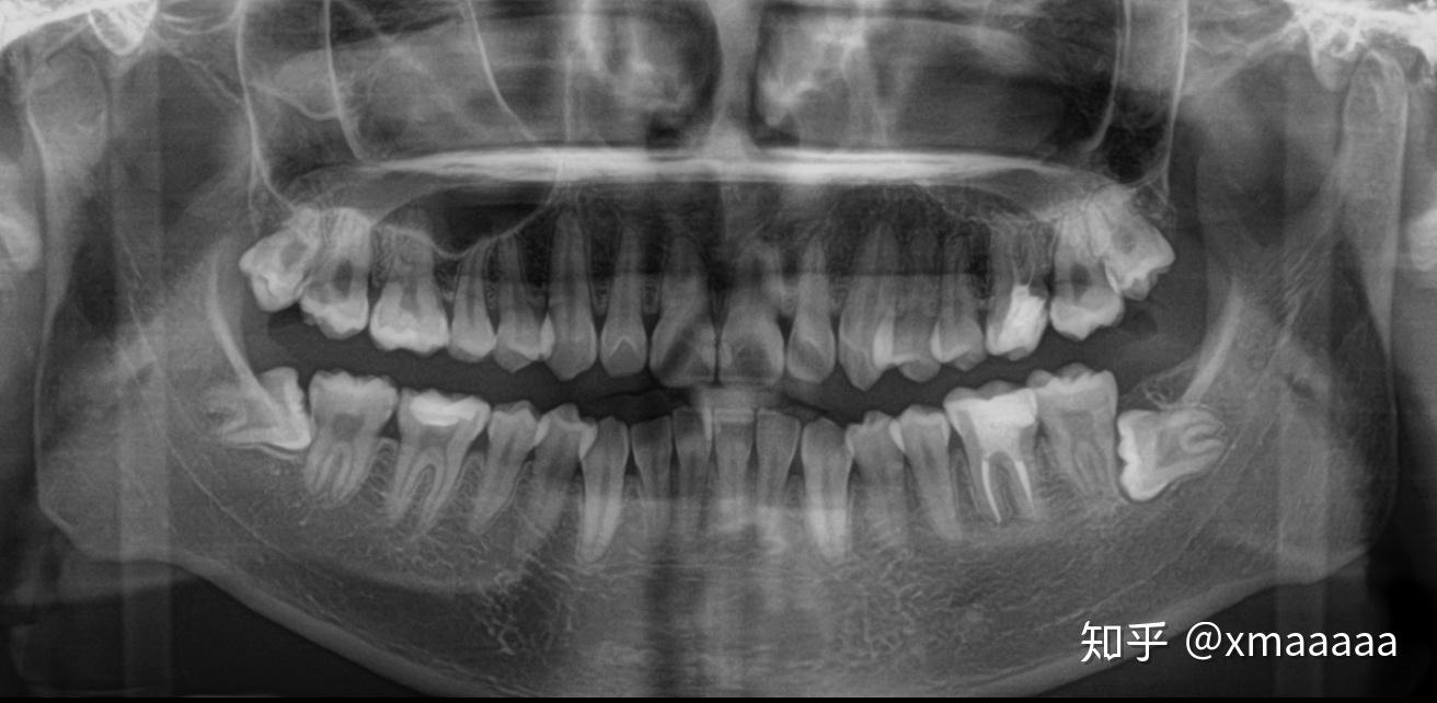 杭州拔智齿经历