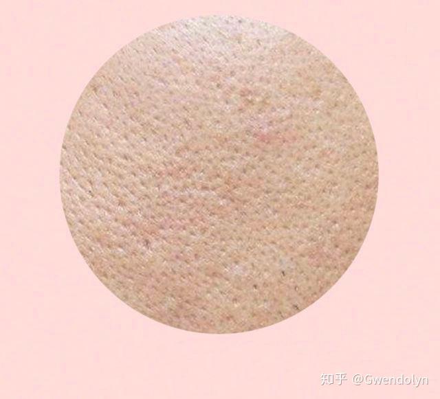 缺水型毛孔粗大