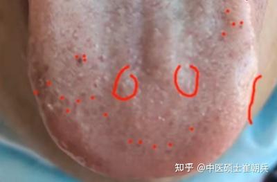 今日舌诊—实战分析—女性肾虚腰酸乏力,乳腺增生如何调理? - 知乎