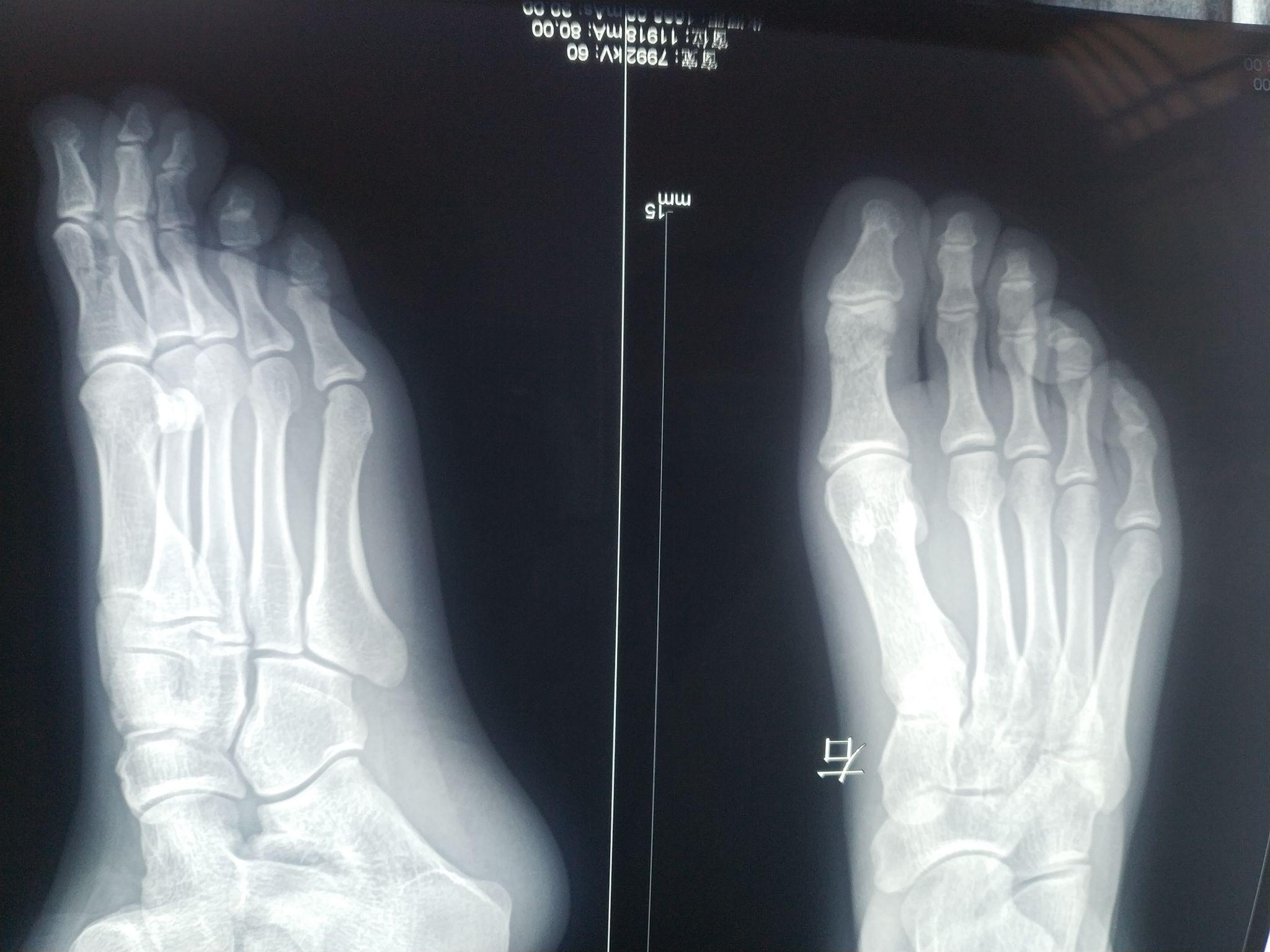 大拇脚趾头骨折 如何快速恢复?