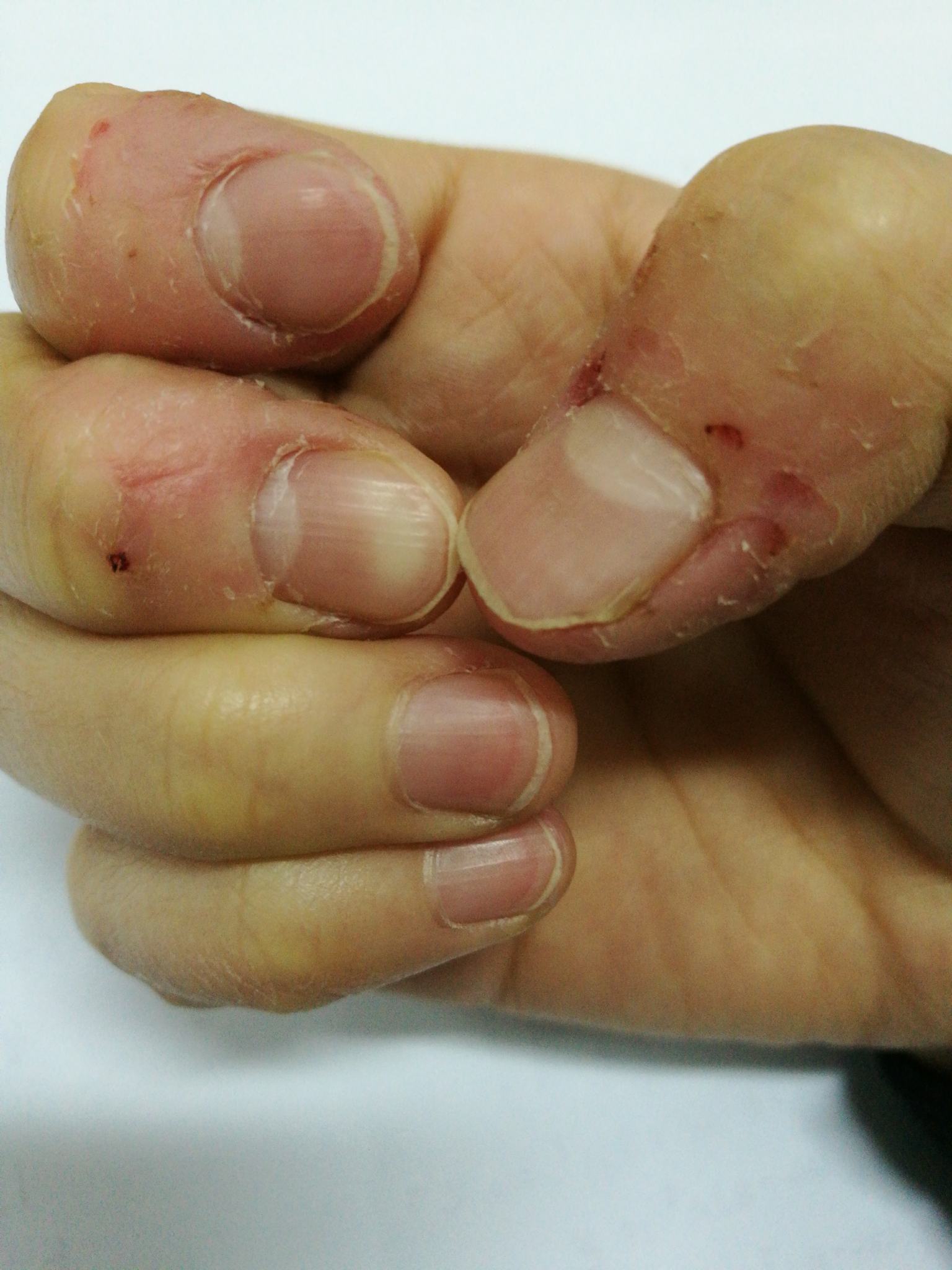 男子多个脚趾手指外翻畸形 类风湿性关节炎是“幕后黑手”_新闻动态_医院新闻_福州中德骨科医院