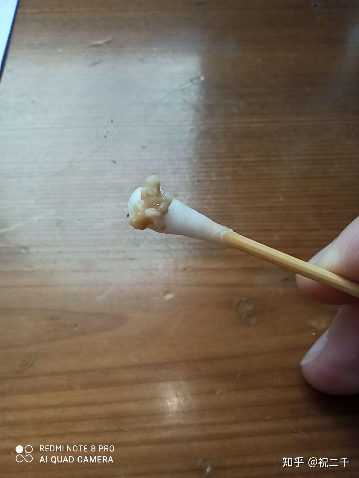 为什么扁桃体结石那么臭