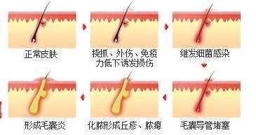 毛囊炎、疖、痈、皮脂腺囊肿怎么区分? - 知乎