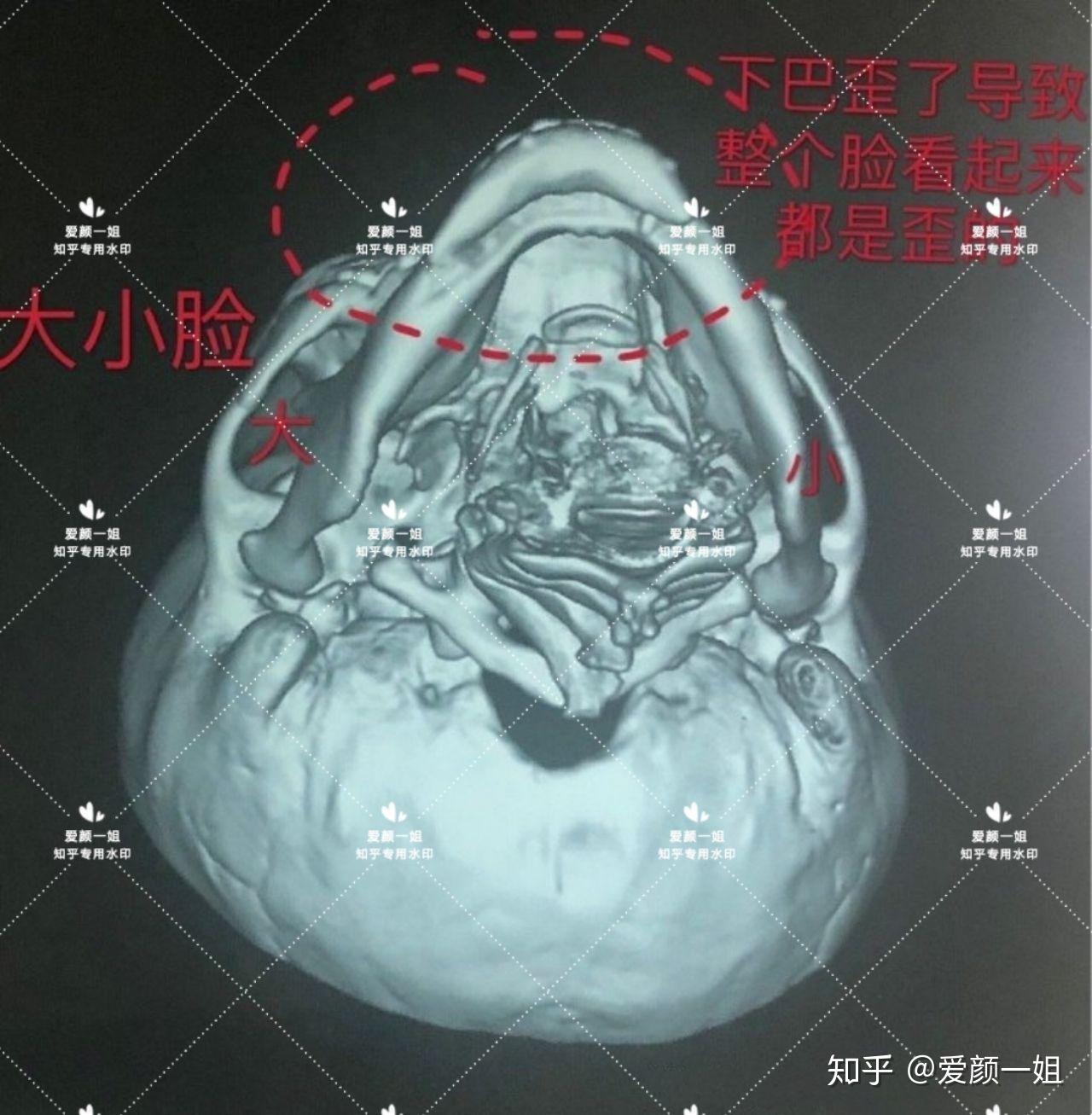 看妹子術後ct,顴骨顴弓內推手術無效果,變化不大,出現明顯大小臉;下頜