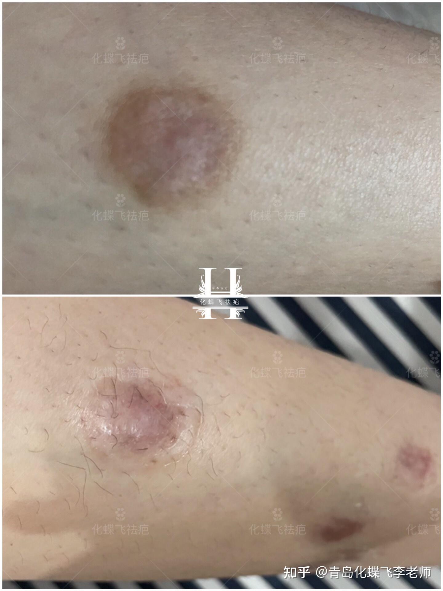 腿上蚊子咬了以后,全是外伤疤痕