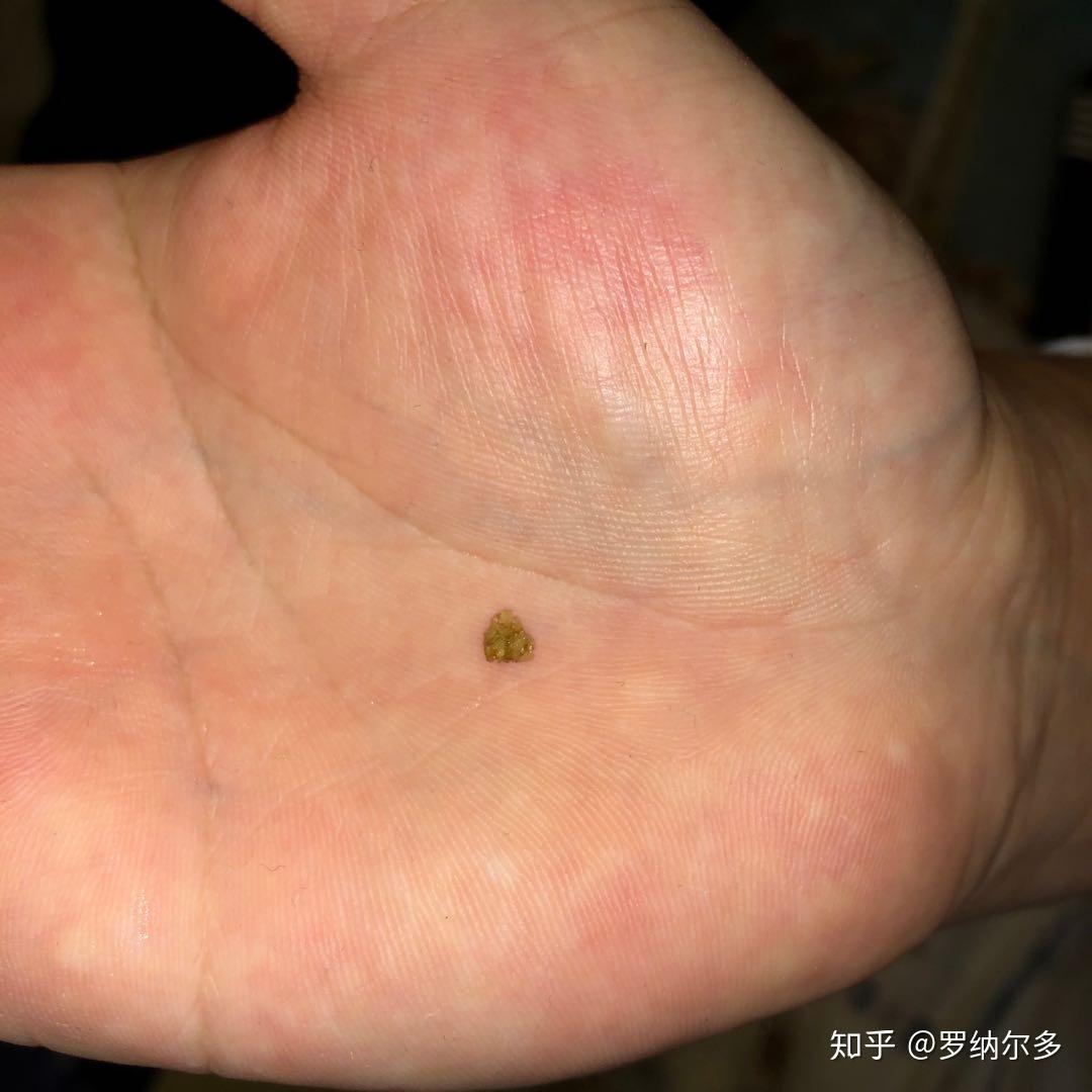 尿结石能排出来么到底什么原因导致尿结石