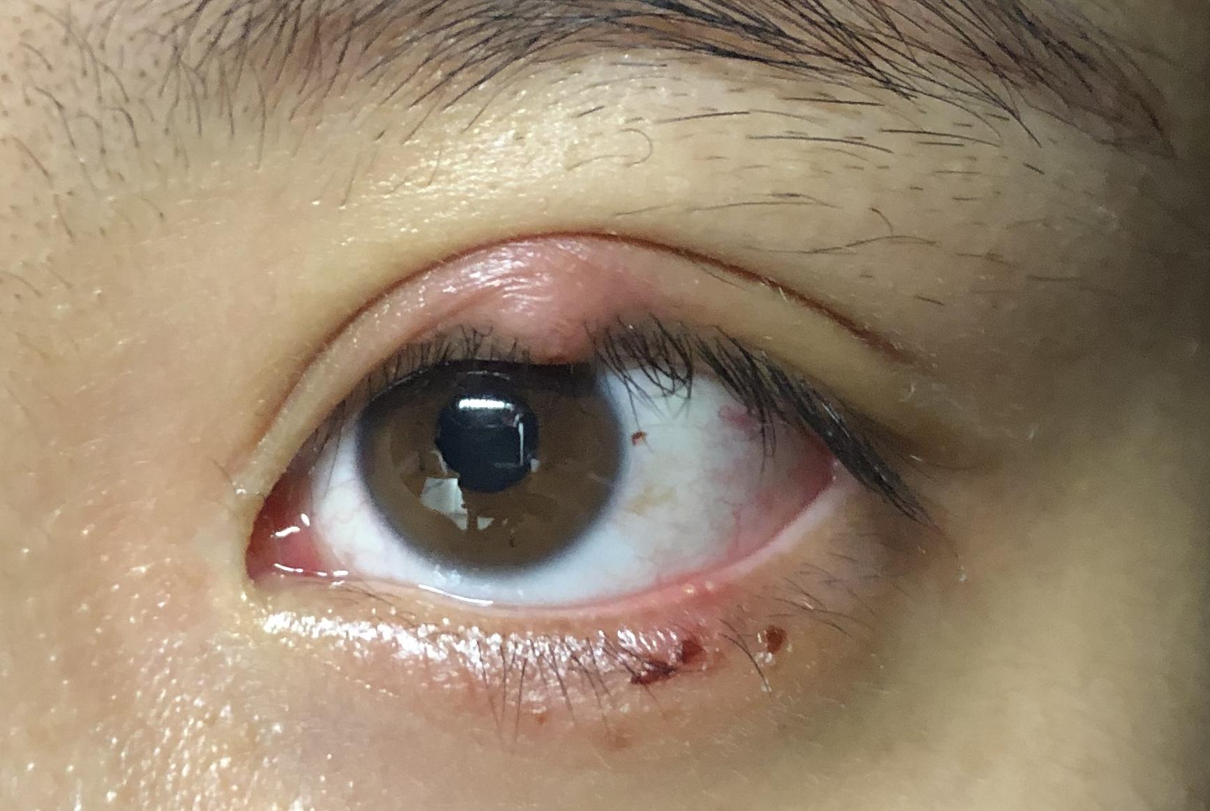有没有得过外麦粒肿的朋友怎么个痊愈过程