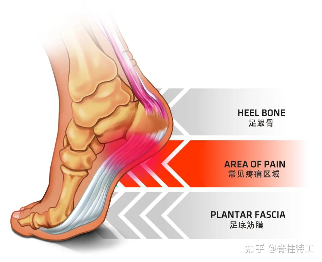 足底筋膜炎专业康复建议收藏