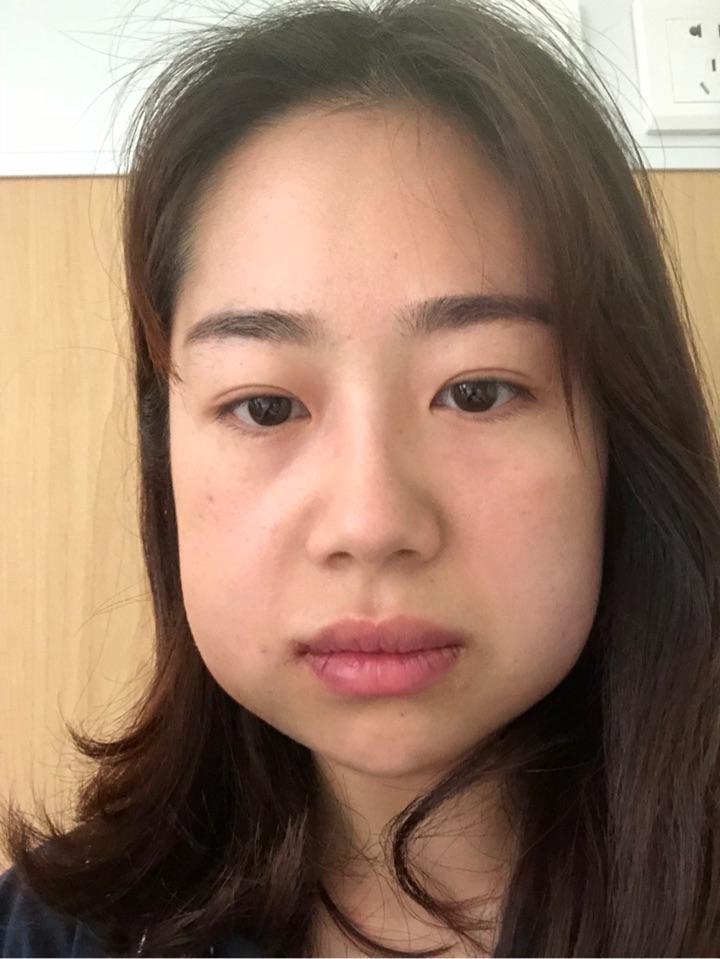 全麻拔智齿的经过