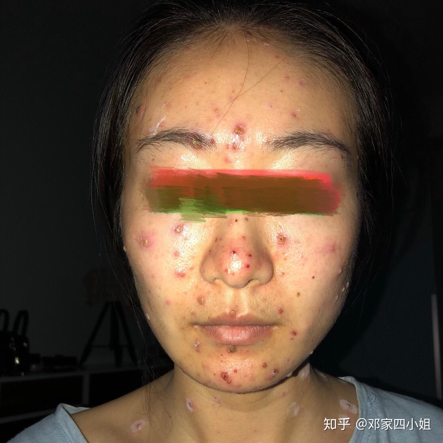 万恶水痘体验记ing