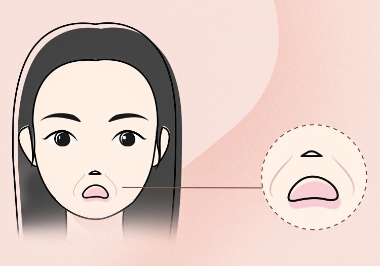 玻尿酸填充法令纹的误区,你知道多少? - 知乎