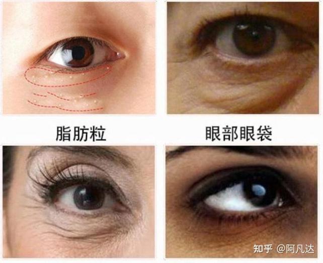 40岁之后这些眼部问题应该怎么解决呢