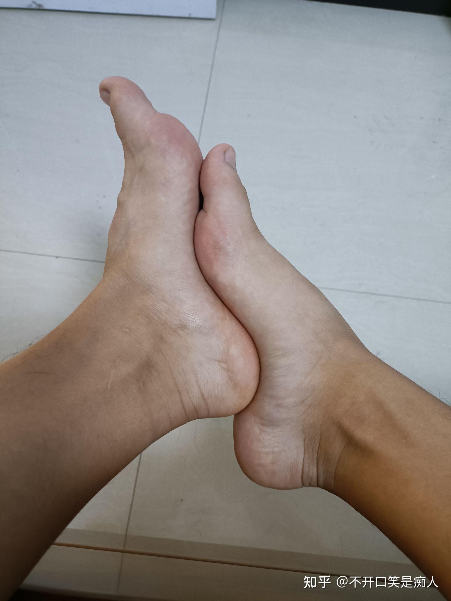 请问我这个是高足弓还是正常足弓,鞋子后跟外侧有磨损? - 知乎