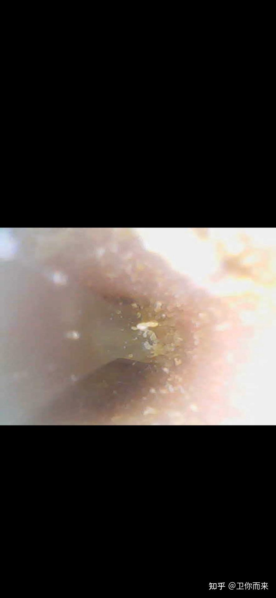 掏出一块超大耳屎,是种什么体验?