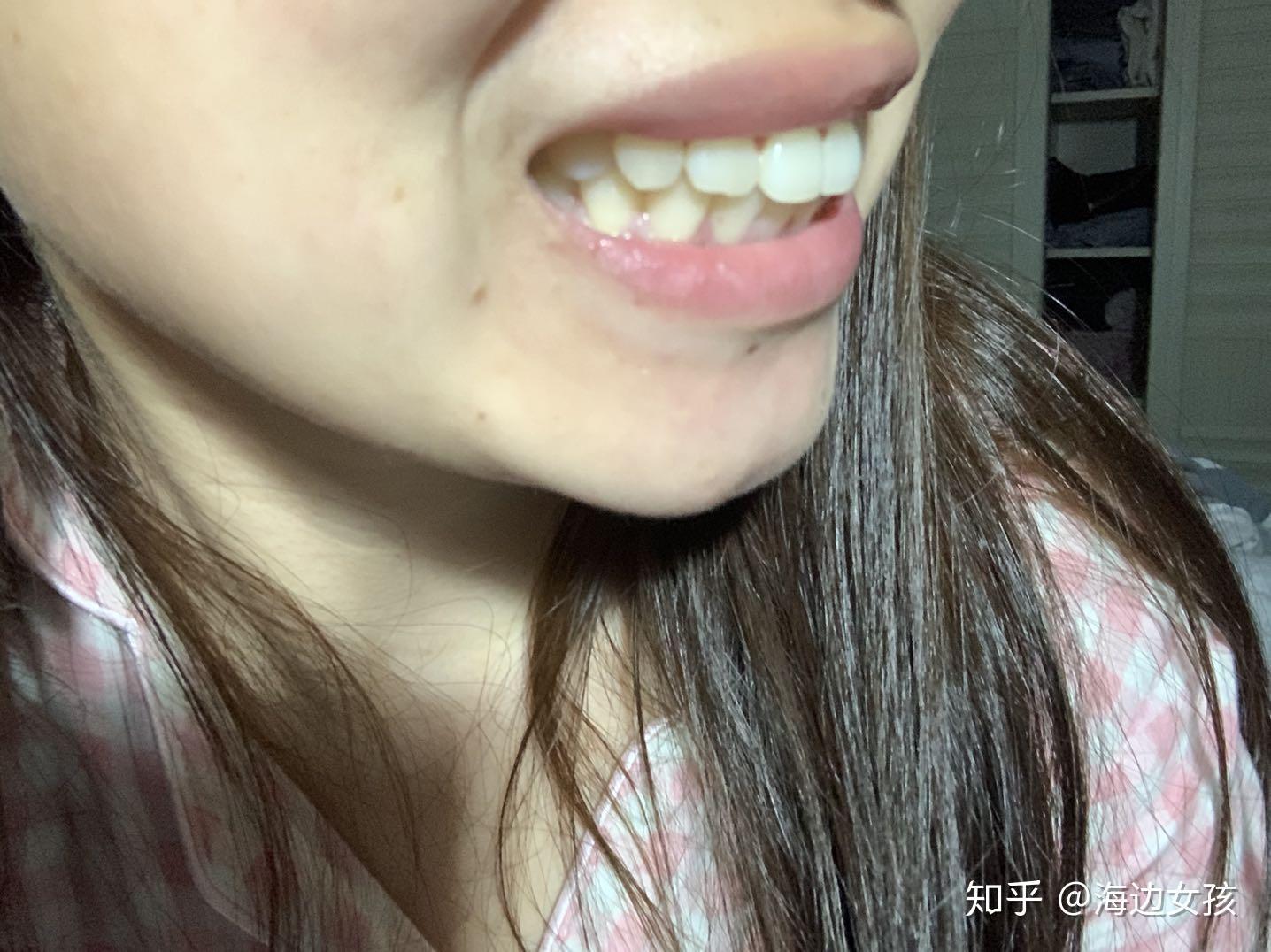 多少岁不会再长智齿 v2-b5c261850a388ed53fe6d1f758a07788_r.jpg