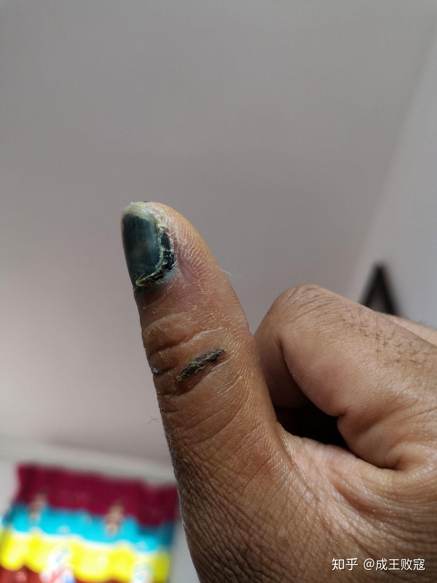 指甲受伤了 - 知乎
