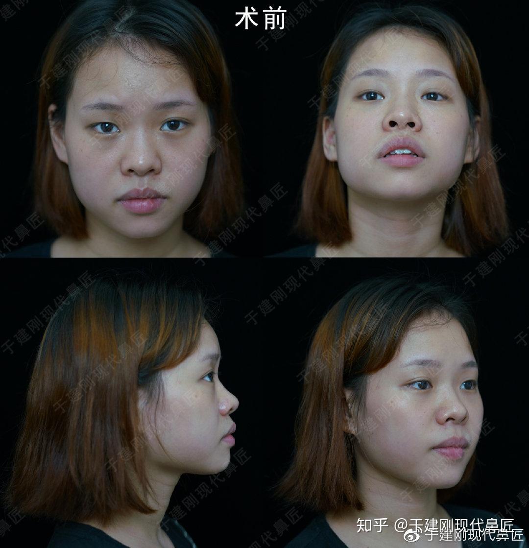 短鼻延长矫正朝天鼻拒绝做难看的猪猪女孩