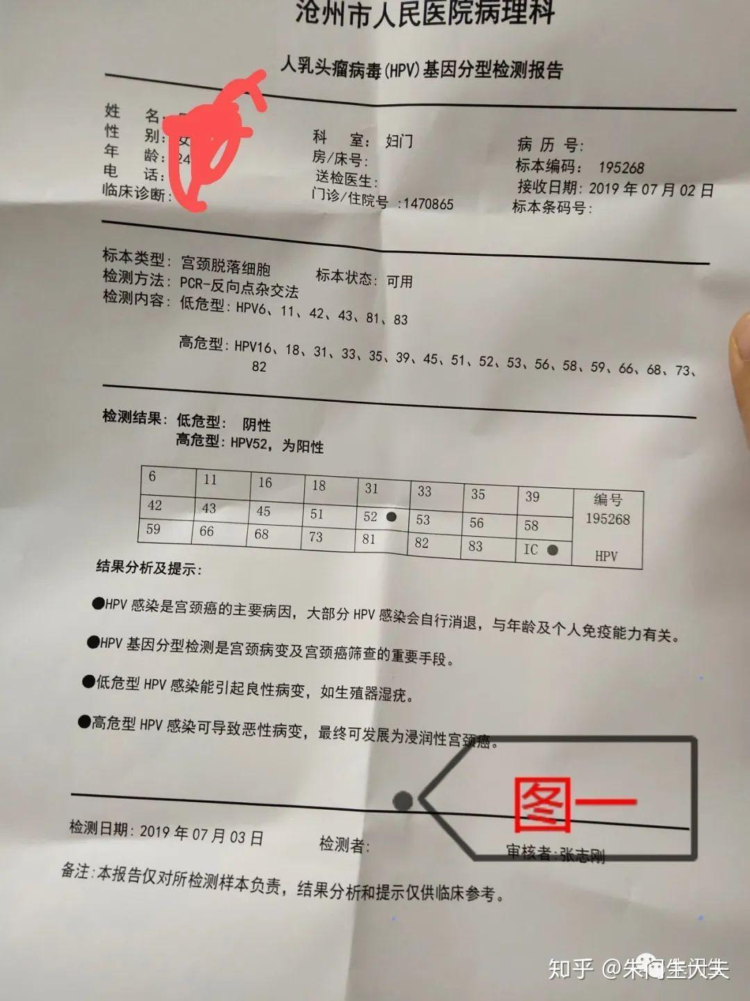 沧州市吴女士hpv52型高危转阴病例分享