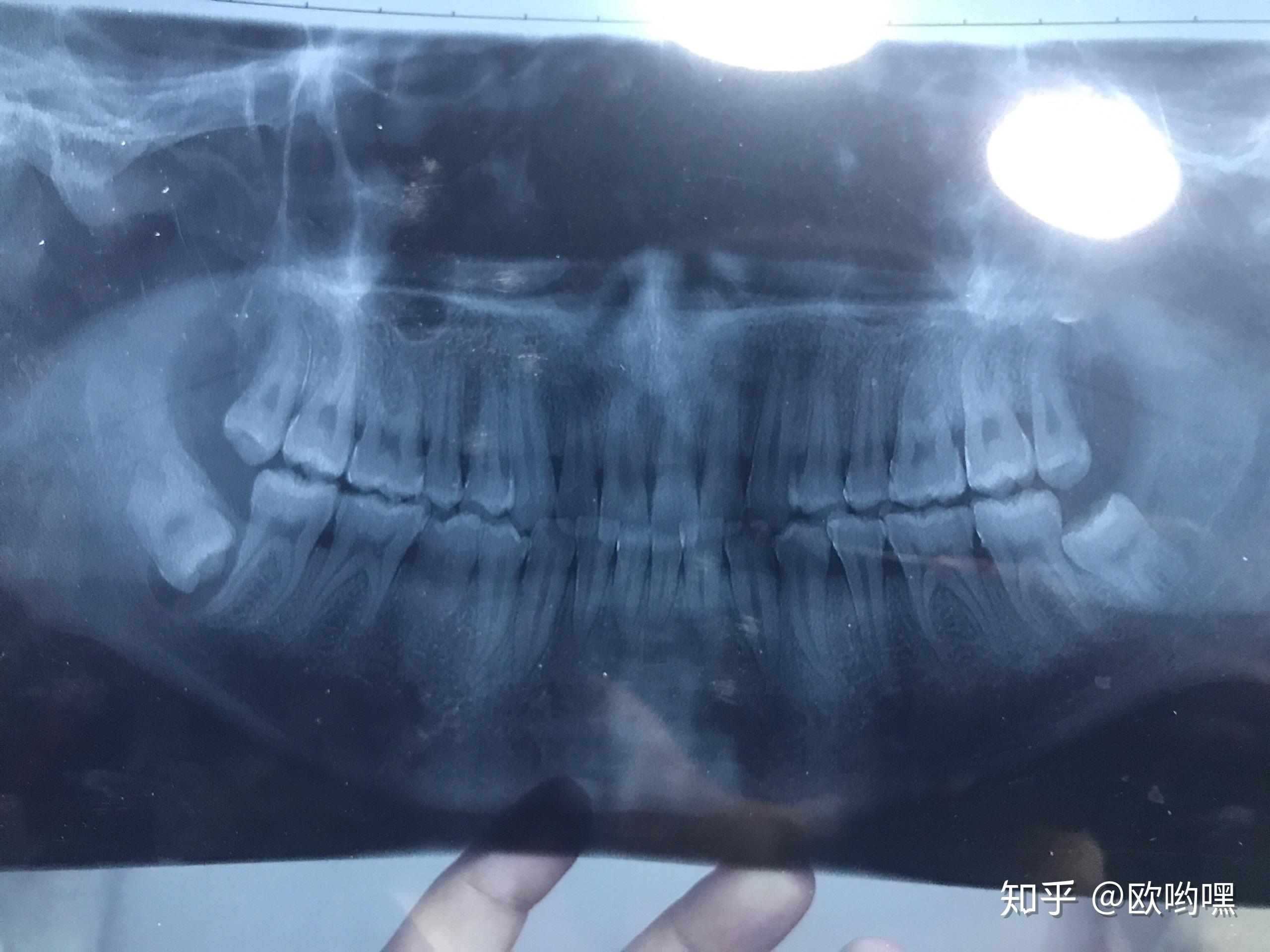 术前准备,抽血查了五项,做了心电图,做了ct,做了核酸检测(因为住院