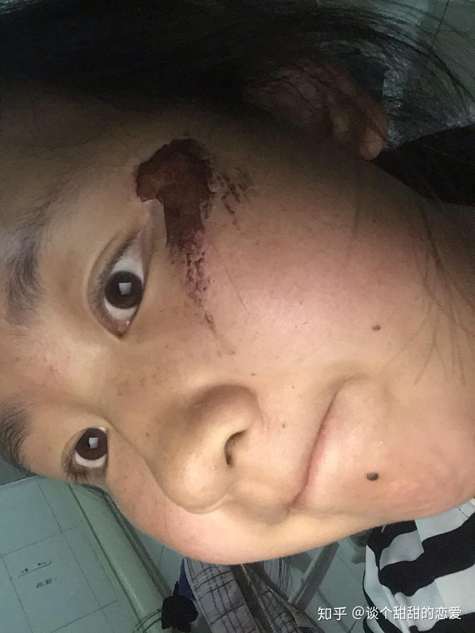 脸部擦伤如图,请问如何恢复? - 知乎
