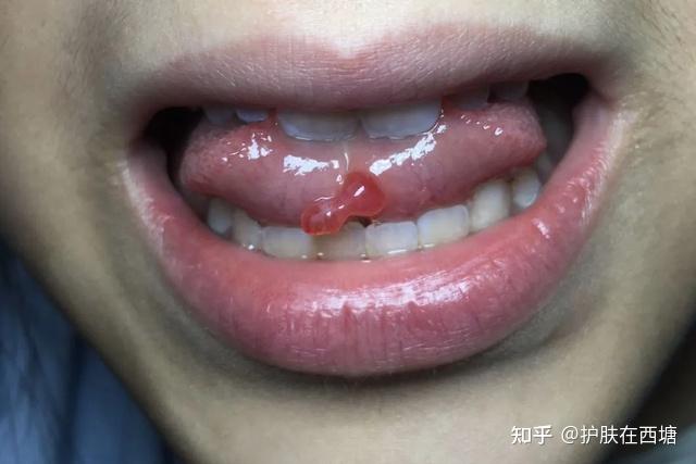嘴巴里长了个"疱",原来是粘液囊肿!