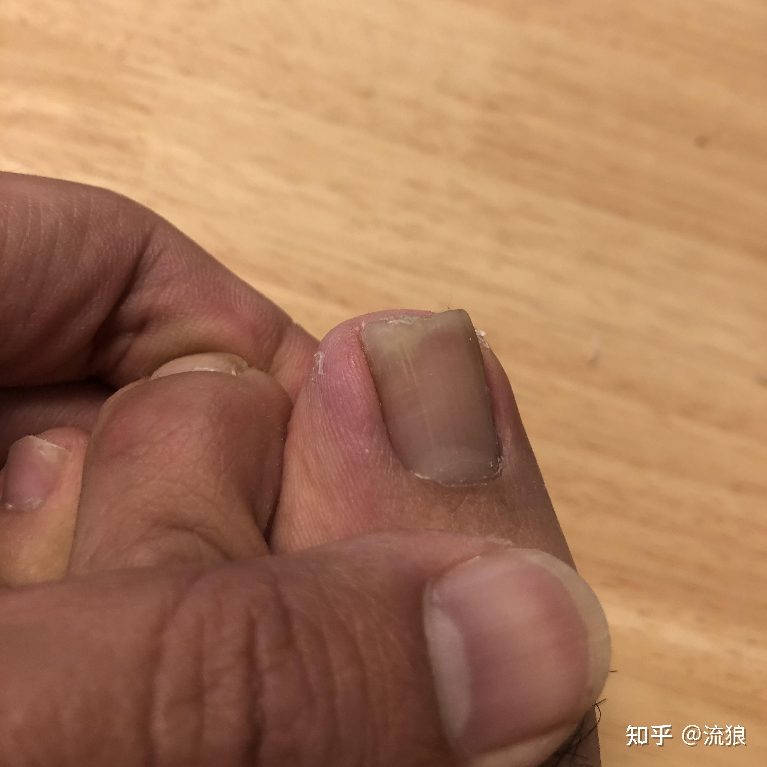 脚趾大拇指指甲两侧往肉里长怎么办啊? - 知乎