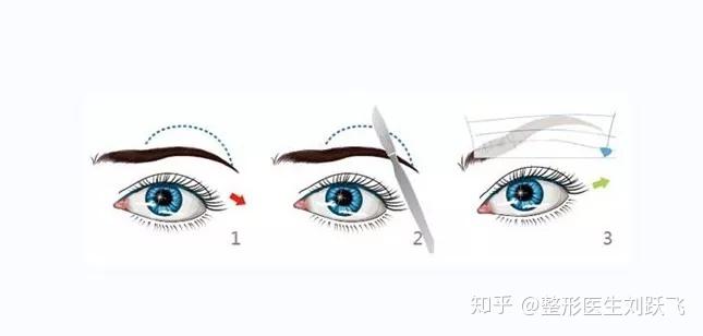 提眉术要根据眉形设计切口,根据求美者的眉下垂程度,制定切除皮肤的