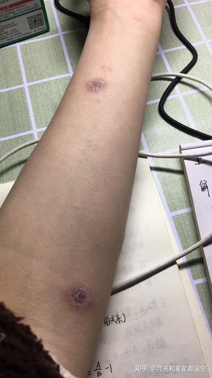 丘疹性荨麻疹留下的疤痕怎么去除
