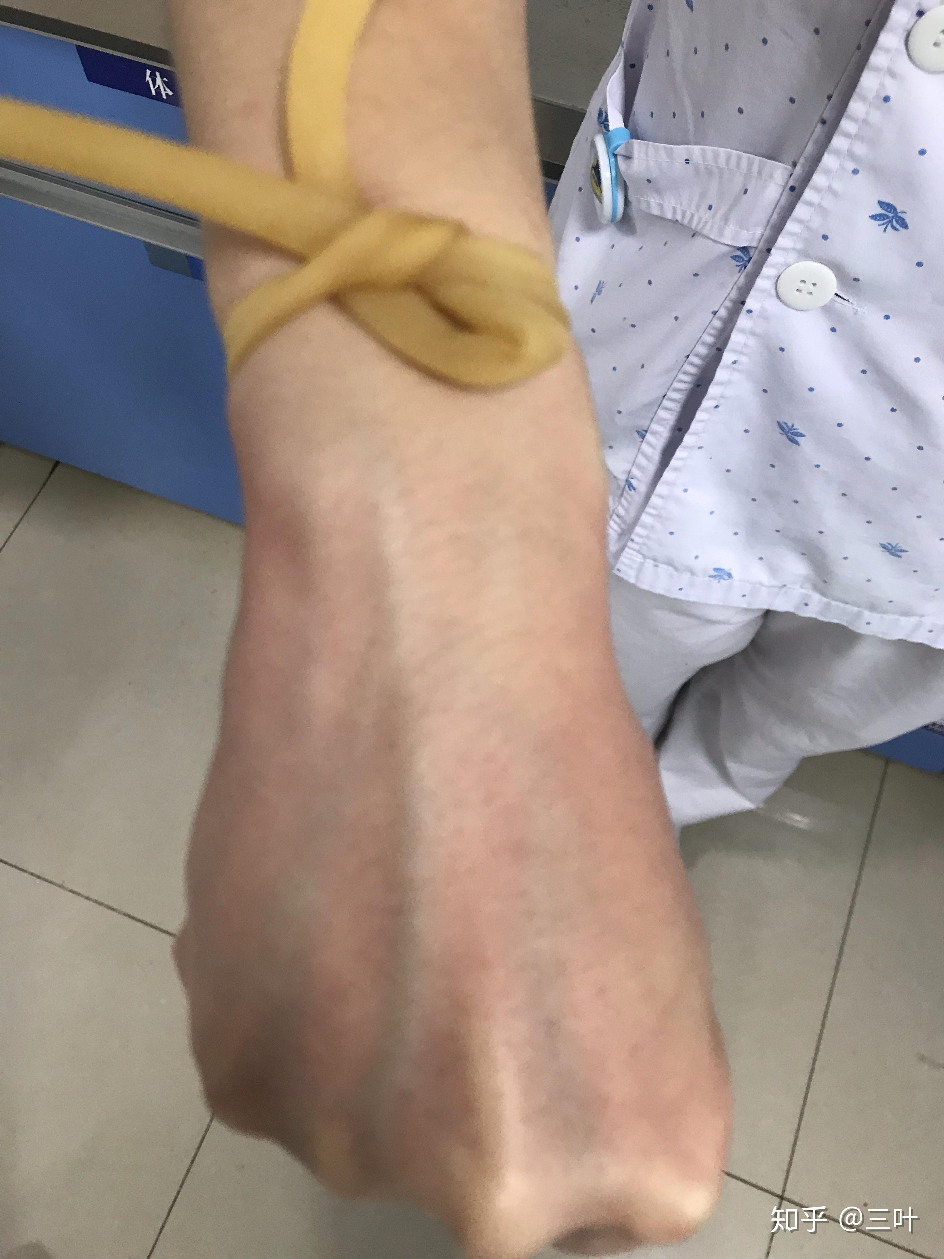 护士扎针技术很烂怎么办