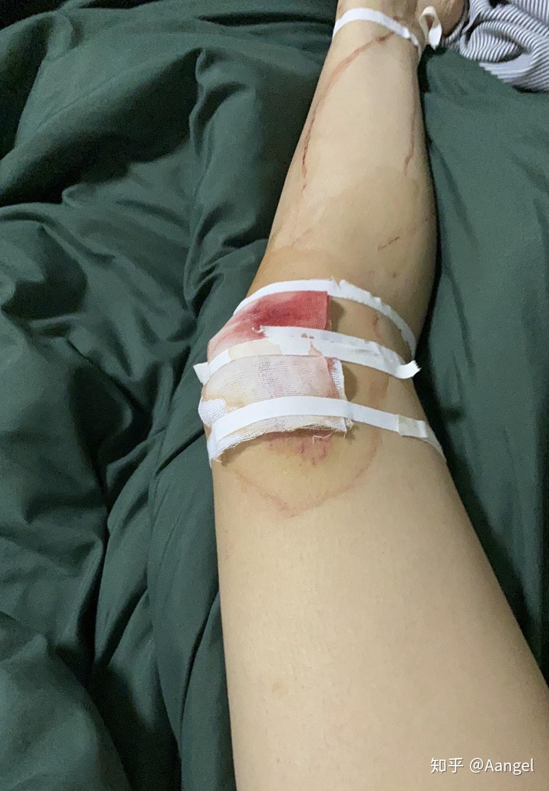 骑车侧翻膝盖摔伤破皮,怎么处理伤口,怎样才能不留疤?