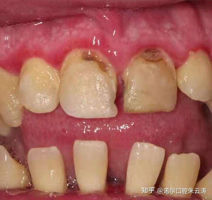 洗牙后让牙结石占据的空间可能让牙龈再长回去充满吗