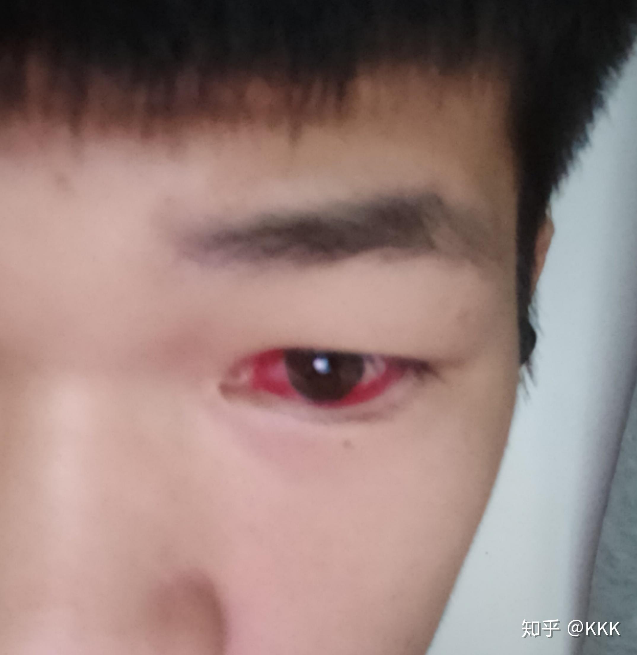 打球时被撞到眼球黑眼珠下面的白眼球有一点血块视力没有影响有事吗