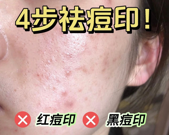 【祛痘印必看】买了好多祛痘印精华，可痘印还是死死扒在脸上？你需要了解痘印产生的原因对症下药了！ - 知乎