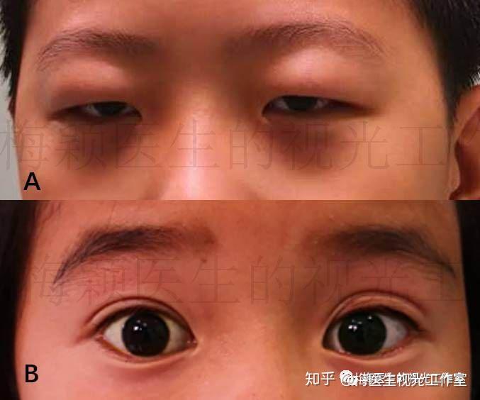 按经验,睑裂小,眼睑肥厚,眼睑紧的儿童(图4 a)塑形时,镜片容易受眼睑