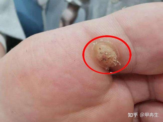 刺瘊,跖疣?怎么应对它