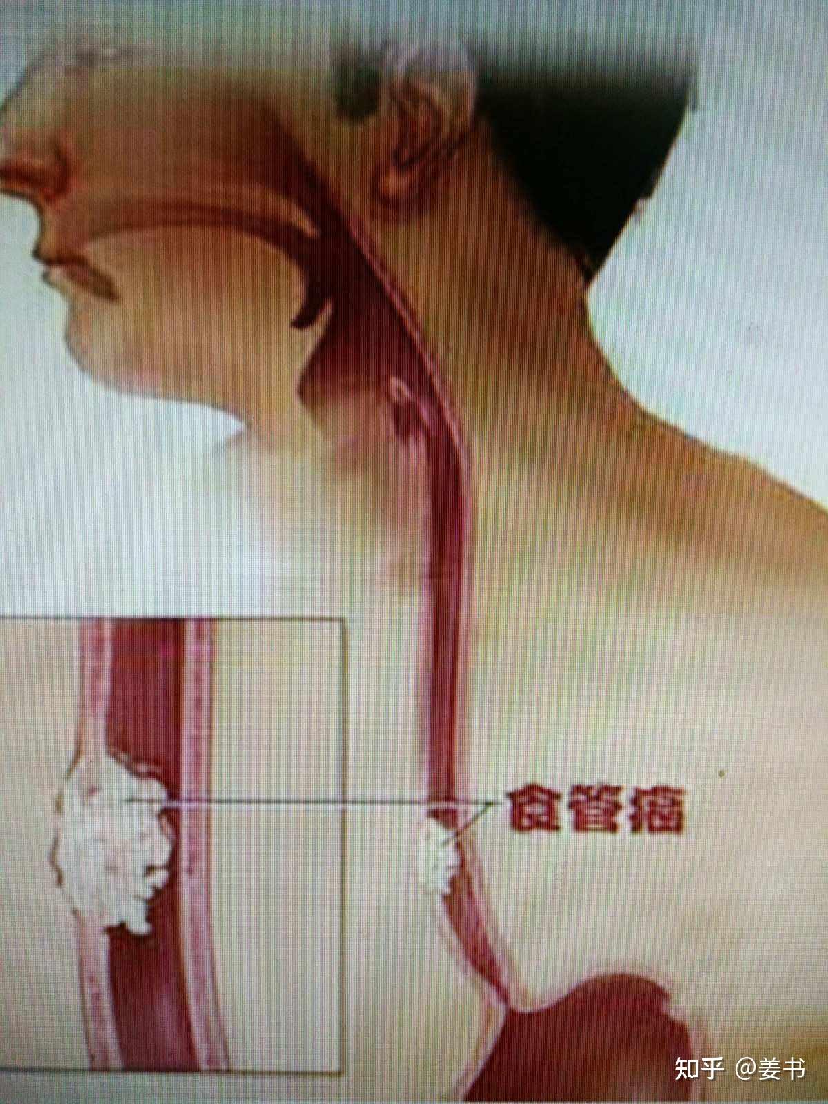 食道癌的早期症状和前兆是什么?