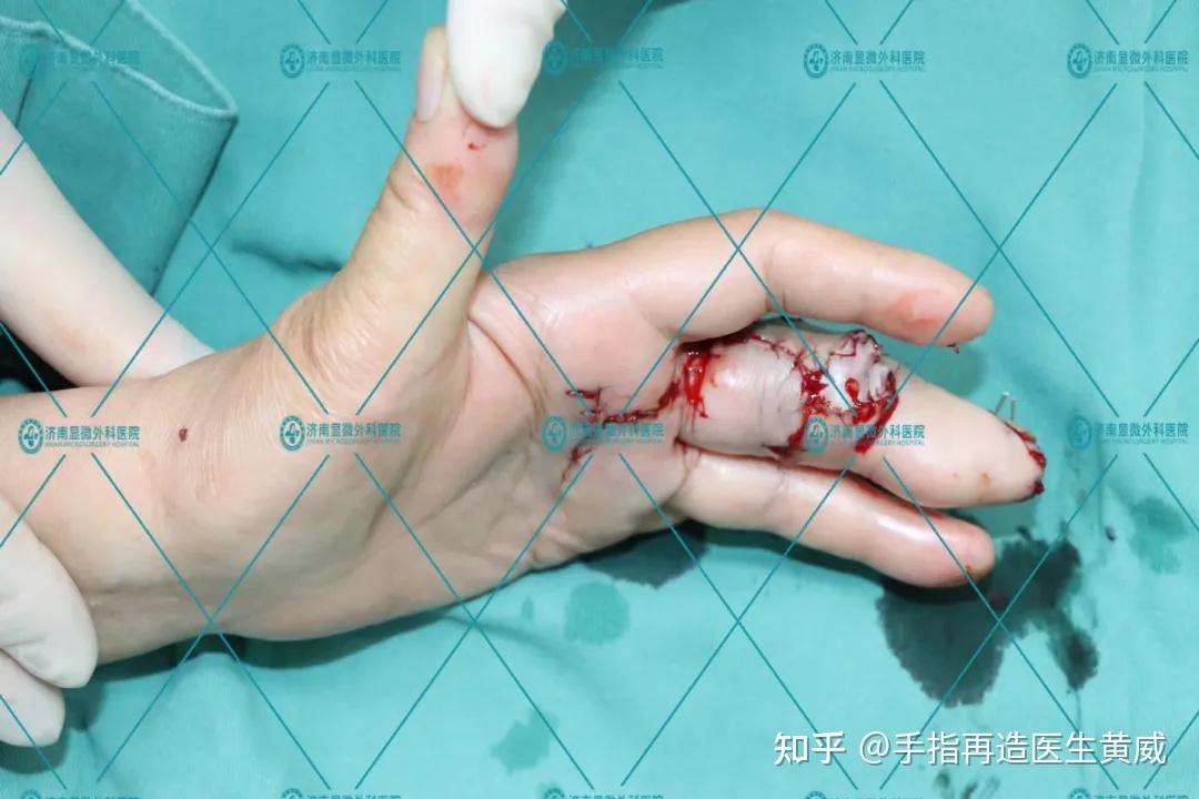 3d全形手指再造找回62岁阿姨全部自信