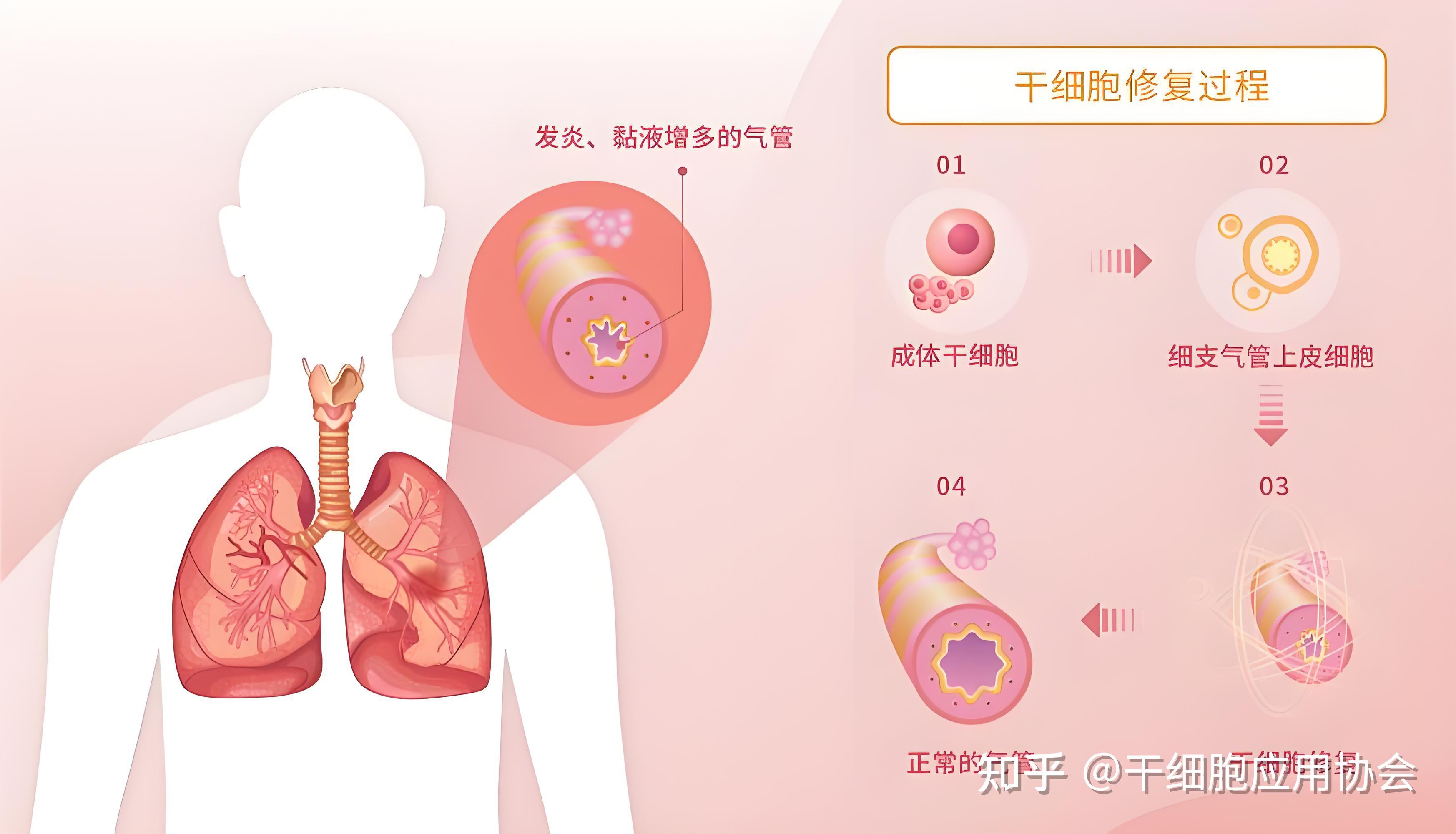 干细胞可以治疗哪些疾病?