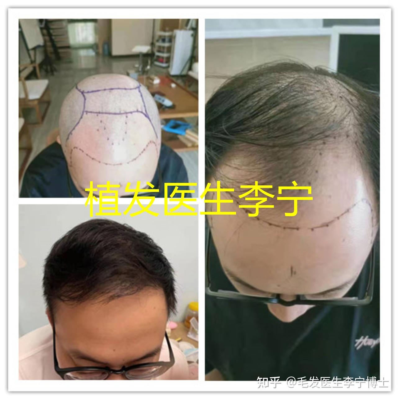 盘点上海九院做植发比较知名的医生！（附植发案例对比图）-发友网