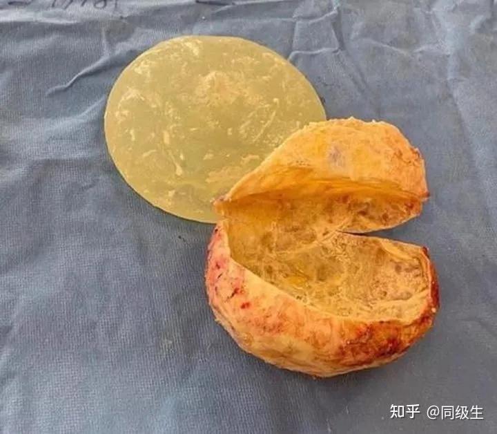 胸假体取出亲身经历,自体脂肪丰胸后5年后坏死? - 知乎