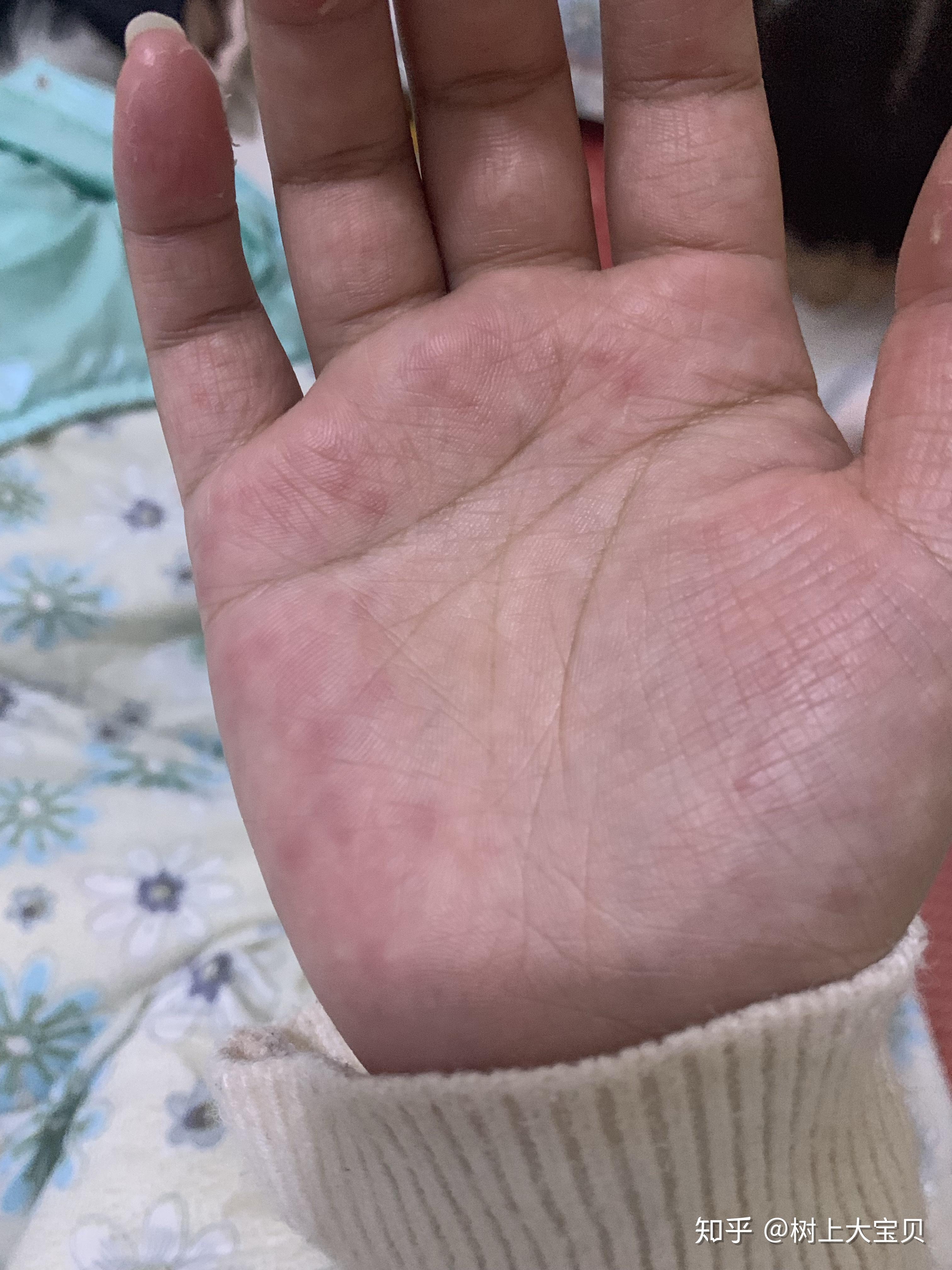 有对洗衣粉洗衣液过敏的人吗? - 知乎