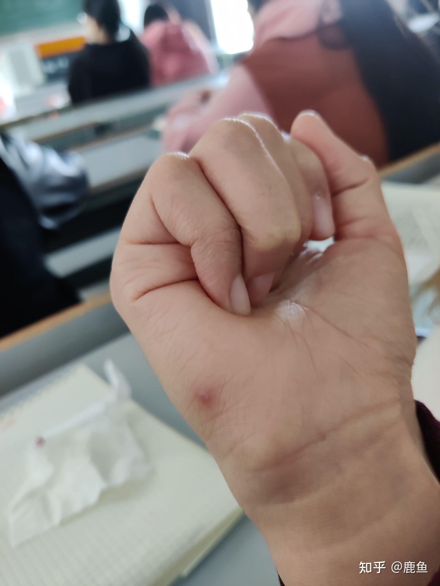 手扎刺如果不挑出来会有怎样的后果? - 知乎