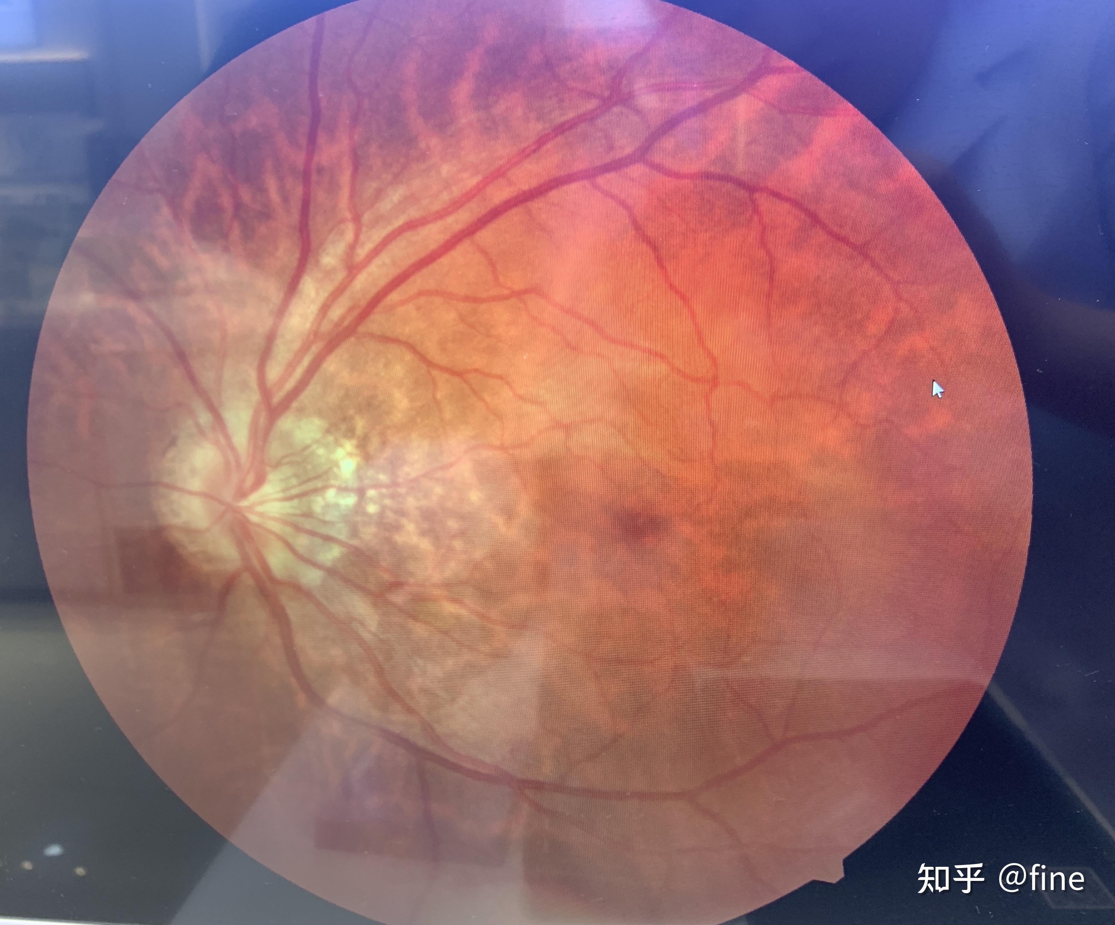近视视网膜成像图片
