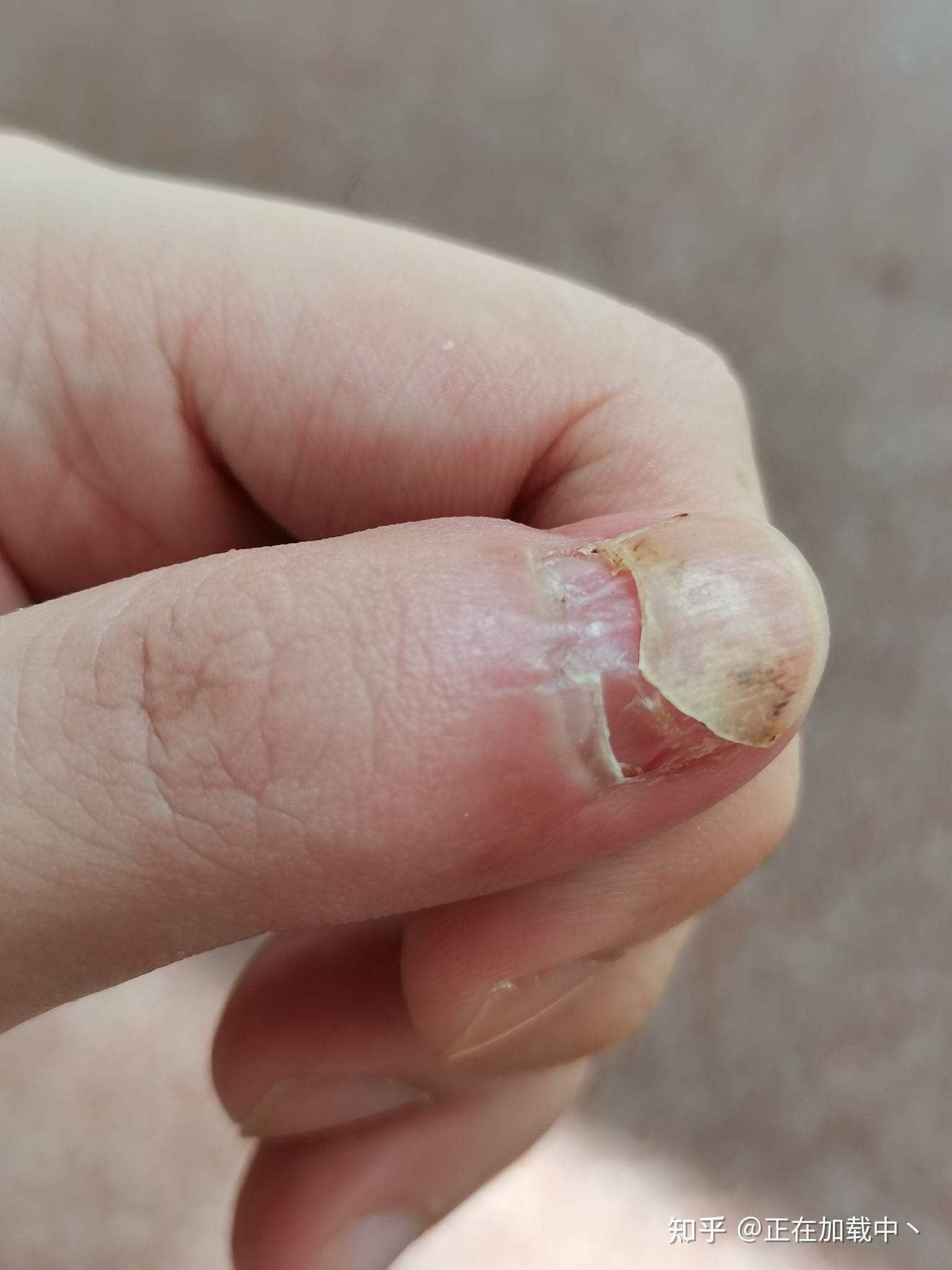 手指动了手术指甲根部拔了还能不能长出来