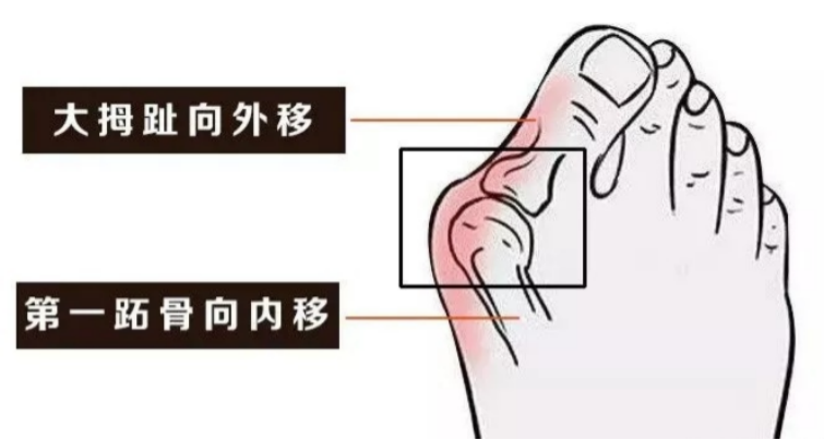 什么是拇外翻？有没有人做过大脚骨（拇指外翻）的手术，效果怎么样？有没有后遗症？医院医生有哪些推荐？ - 知乎